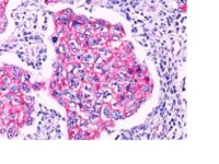 FFPE breast carcinoma, ductal sections stained with 100 ul anti-beta-Catenin (clone Polyclonal) at 1:200. HIER epitope retrieval prior to staining was performed in 10mM Tris 1mM EDTA, pH 9.0.